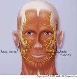 Bells palsy