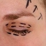 droopy-eyelids