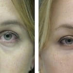 Lower Lids Filler