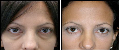 lower eyelids blepharoplasty