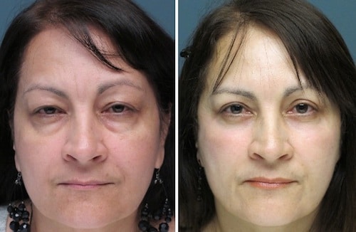 1 upper lower lids blepharoplasty-000