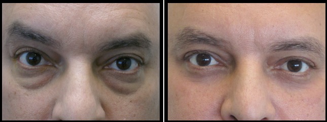 lower eyelids blepharoplasty