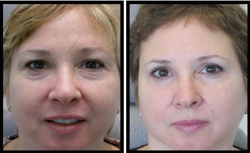 10 upper lower lids blepharoplasty-010