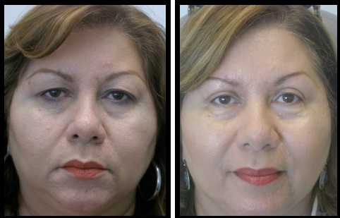 upper eyelids blepharoplasty-012