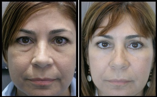 11 upper lower lids blepharoplasty-011