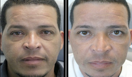 lower eyelids blepharoplasty