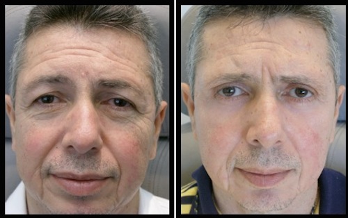 2 upper lower lids blepharoplasty-001