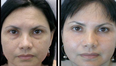 lower eyelids blepharoplasty