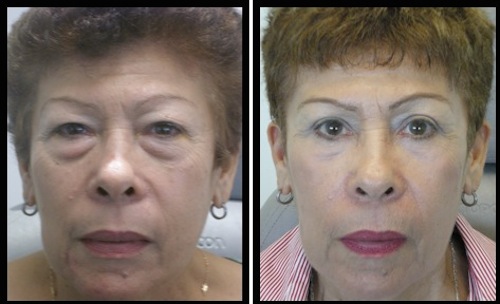 3 upper lower lids blepharoplasty-002