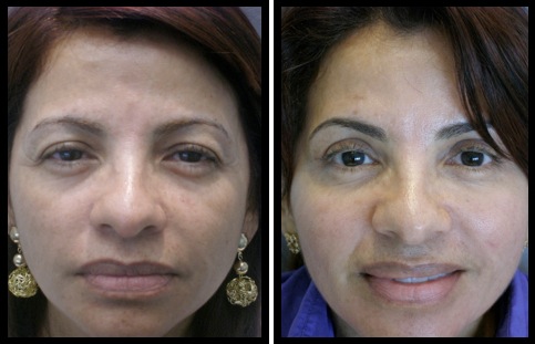 upper eyelids blepharoplasty-004