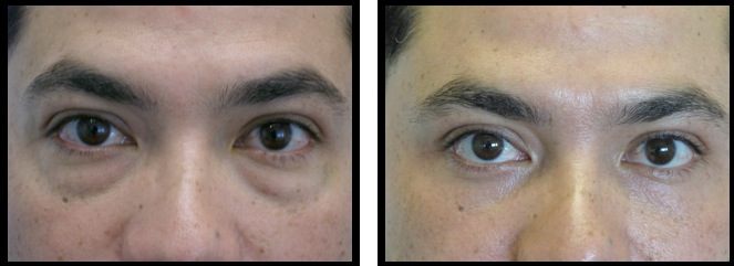 lower eyelids blepharoplasty