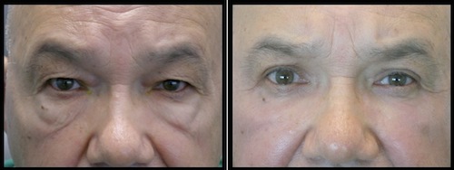 4 upper lower lids blepharoplasty-003