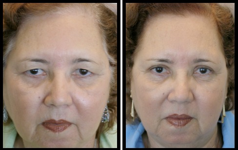 upper eyelids blepharoplasty-005