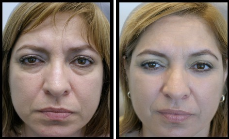 lower eyelids blepharoplasty