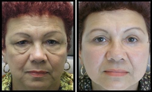 5 upper lower lids blepharoplasty-004