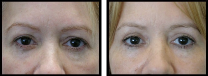 upper eyelids blepharoplasty-006