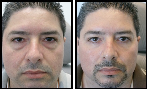 lower eyelids blepharoplasty