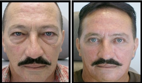 6 upper lower lids blepharoplasty-005