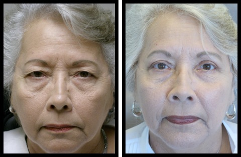 upper eyelids blepharoplasty-007