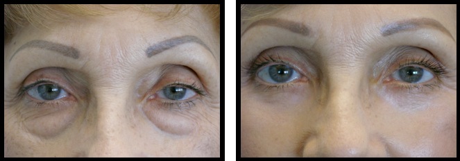 lower eyelids blepharoplasty