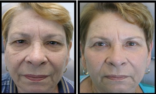 7 upper lower lids blepharoplasty-006