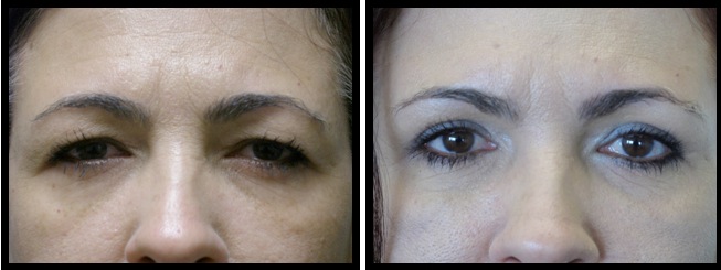 upper eyelids blepharoplasty-008