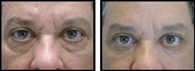 lower eyelids blepharoplasty