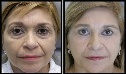 8 upper lower lids blepharoplasty-008