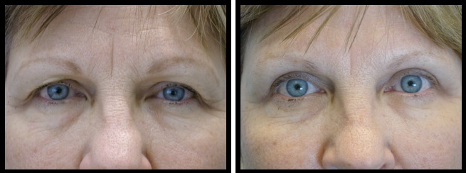 upper eyelids blepharoplasty-009