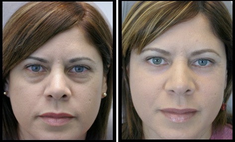 lower eyelids blepharoplasty