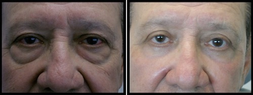 9 upper lower lids blepharoplasty-009