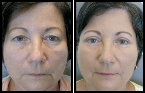 upper eyelids blepharoplasty-010