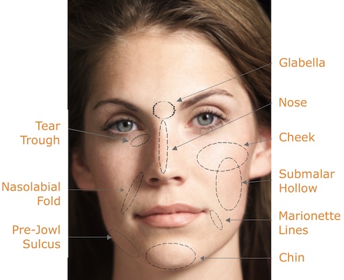 Dermal Fillers