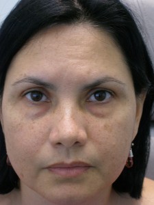 panfacial rejuvenation