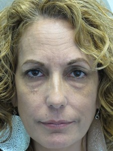 panfacial rejuvenation