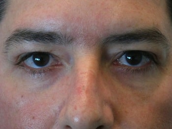 Lower lids surgery Lower lids surgery: