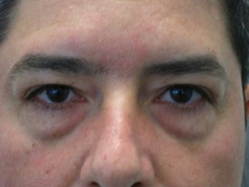 Lower lids surgery Lower lids surgery