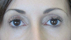 Lower lids surgery Lower lids surgery:
