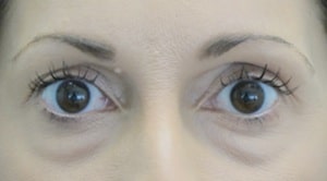 Lower lids surgery Lower lids surgery
