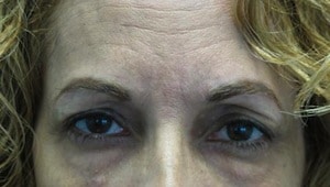 dermal filler