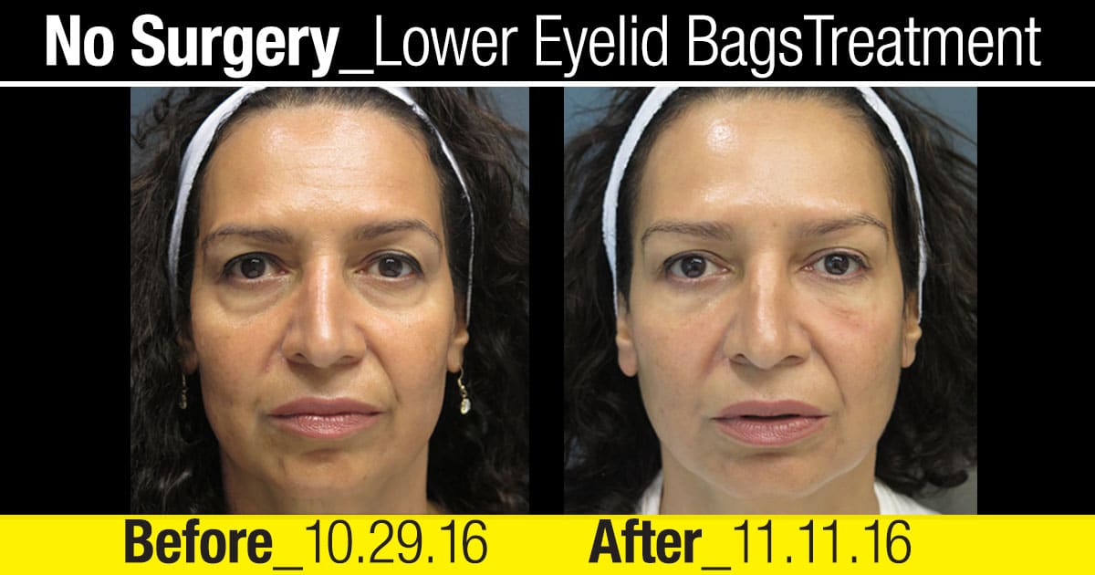 cbc-nyc-2016-patient-testimonial-no-surgery-lower-eyelid-treatment