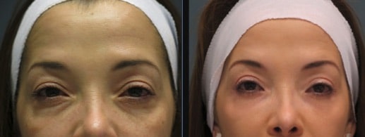 Four lids Blepharoplasty Testimonial