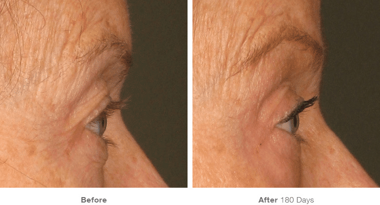 Ultherapy, Face Lift, Non-surgical Lift, Brow Lift