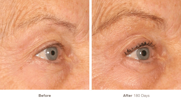 Ultherapy, Face Lift, Non-surgical Lift, Brow Lift