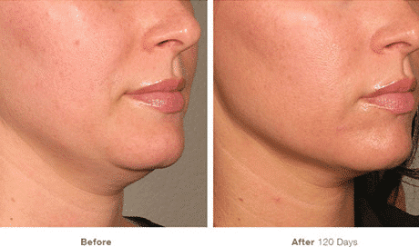 Ultherapy, Non-Invasive Lift, Face Lift, Non-surgical Lift