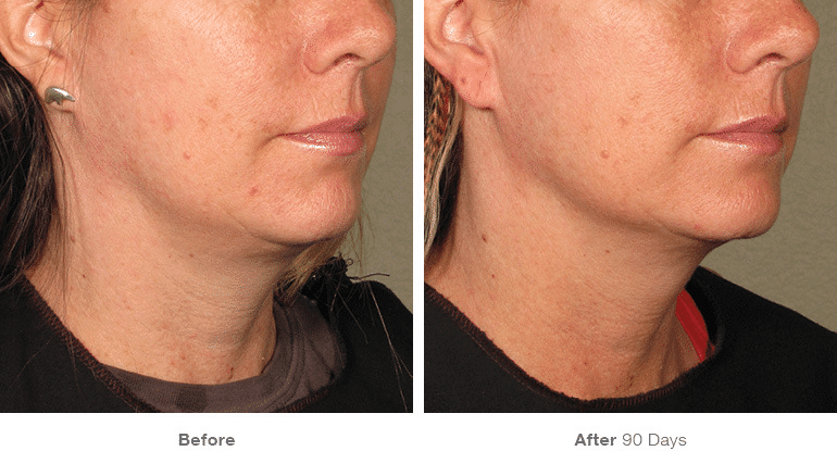 Ultherapy, Face Lift, Non-surgical Lift