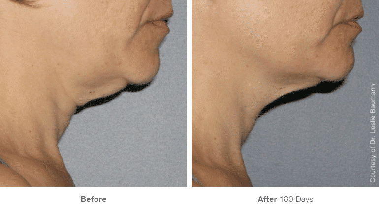 Ultherapy, Face Lift, Non-surgical Lift, Neck Lift