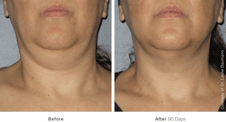 Ultherapy, Face Lift, Non-surgical Lift, Neck Lift