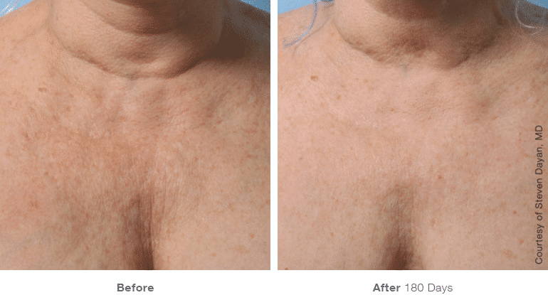Ultherapy, Face Lift, Non-surgical Lift, Chest