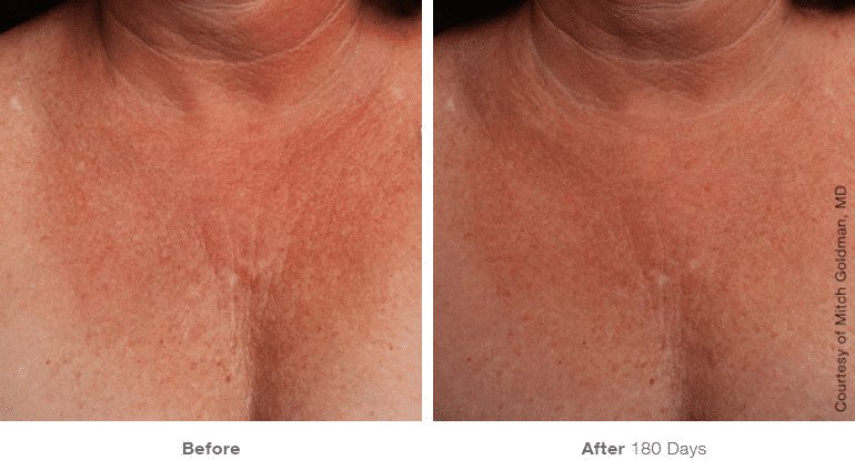 Ultherapy, Face Lift, Non-surgical Lift, Chest
